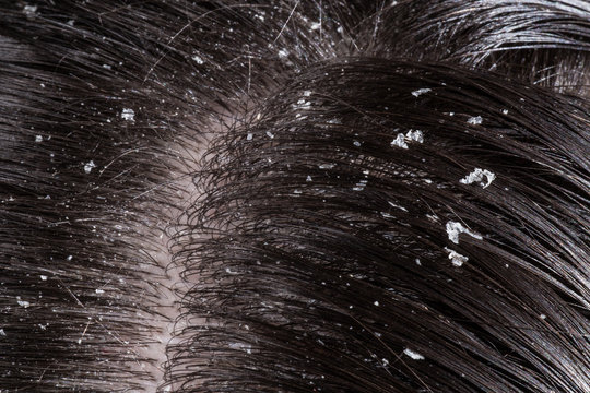 Hair Care: सर्दियों में डैंड्रफ का रामबाण इलाज ये 3 नुस्खे, बालों का झड़ना, उनका असमय सफ़ेद होना, से मिल जायेगा छुटकारा