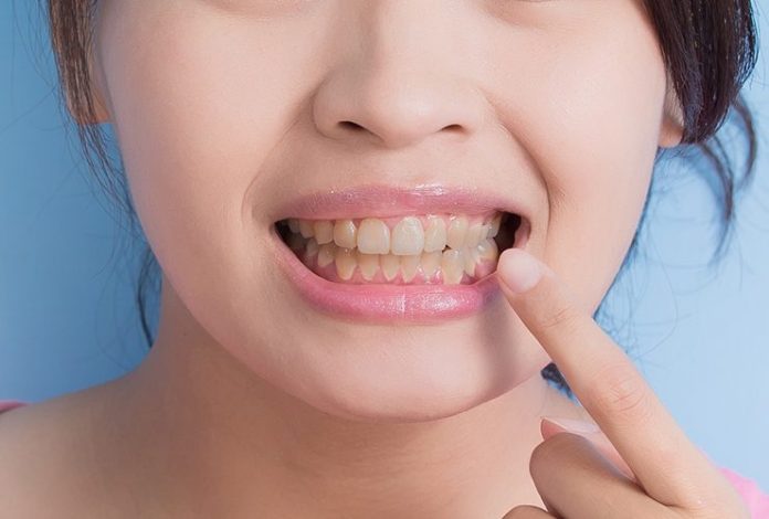 Good News! Teeth whitening at home: पीले दांत से चुट्कियों में पायें छुटटी, सफेद और चमकते दांतों के लिए अपनाएं ये टिप्स