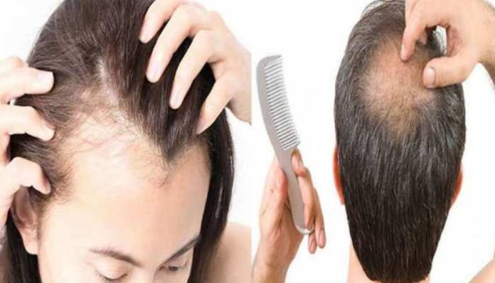 Best Gharelu Upay hair fall: सर्दियों में झड़ते बालों से हैं परेशान ?, अपनाएं ये आसान घरेलू उपाय, मिलेगा कुछ ही दिनों में छुटकारा