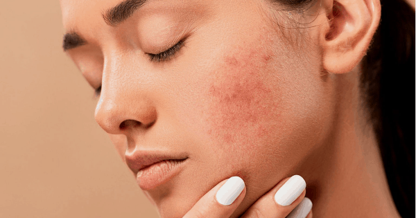 How to care Skin: सिर्फ हल्दी के इस्तेमाल से सप्ताह के अंदर गायब हो जायेंगे मुंहासे और पिंपल्स, चेहरा हो जायेगा चमकदार, जानिए इस्तेमाल करने का तरीका