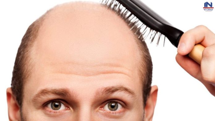 How to prevent baldness: अगर आपके सिर से बाल हो रहें हैं गायब तो अभी से बना लें ये पांच नियम बुढ़ापे तक नहीं करनी पड़ेगी बालों की चिंता
