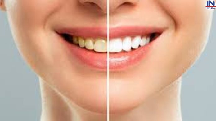 दांतों जमे पीलेपन की चुटकियों में करें छुट्टी जान लीजिए ये देसी नुस्खा, मोतियों जैसे सफेद और चमकदार हो जायेंगे आपके दांत