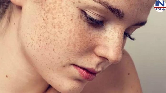 Freckles Treatment: सिर्फ 15 दिनों में चेहरे पे आयी झाइयों को चुटकियों में करें दूर, जानिए कैसे डिटेल्स में