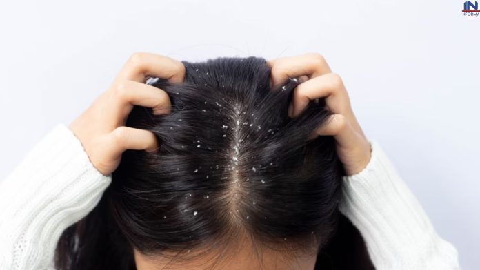 Dandruff Remedies: Having dandruff problem or any other hair problem? Try these two home remedies today, the difference will be visible within two days.
