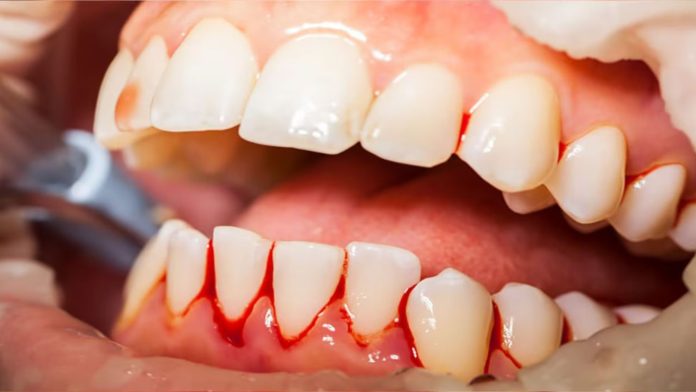 Gum Bleeding dangerous for your health: Know how dangerous bleeding from the gums is, know today the ways to stop bleeding.
