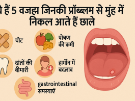 ये हाँ 5 वजह जिनकी प्रॉब्लम से मुंह में निकल आते हैं छाले, करें ये घरेलू उपाय झटपट मिलेगा आराम