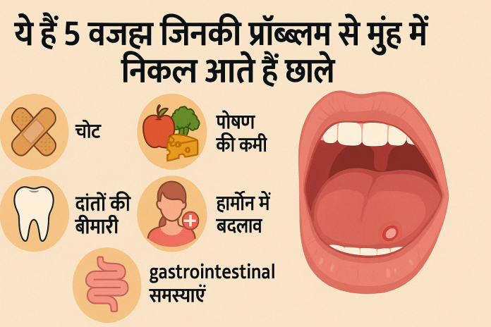 ये हाँ 5 वजह जिनकी प्रॉब्लम से मुंह में निकल आते हैं छाले, करें ये घरेलू उपाय झटपट मिलेगा आराम