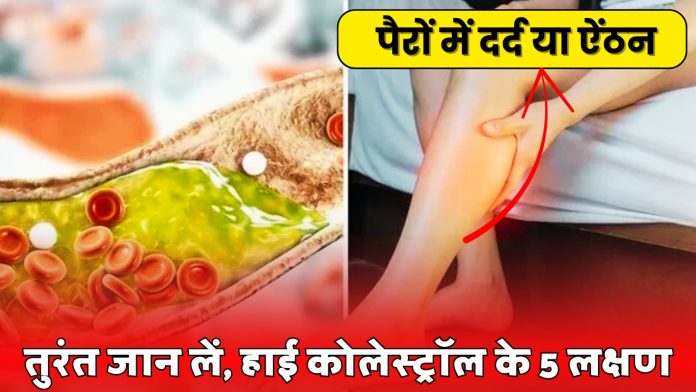 High Cholesterol Symptoms From Leg