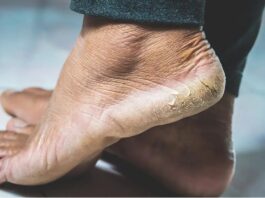Cracked Heels: क्या बारिश के मौसम में आपकी एड़ियाँ फट रही हैं? इन आसान उपायों से तुरंत राहत पाएँ