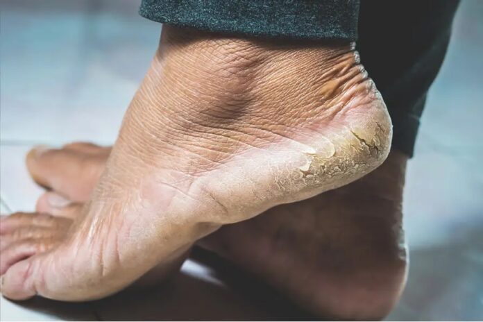 Cracked Heels: क्या बारिश के मौसम में आपकी एड़ियाँ फट रही हैं? इन आसान उपायों से तुरंत राहत पाएँ